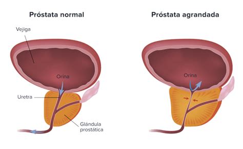 hipertensiune arterială legată de hiperplazie benignă de prostată